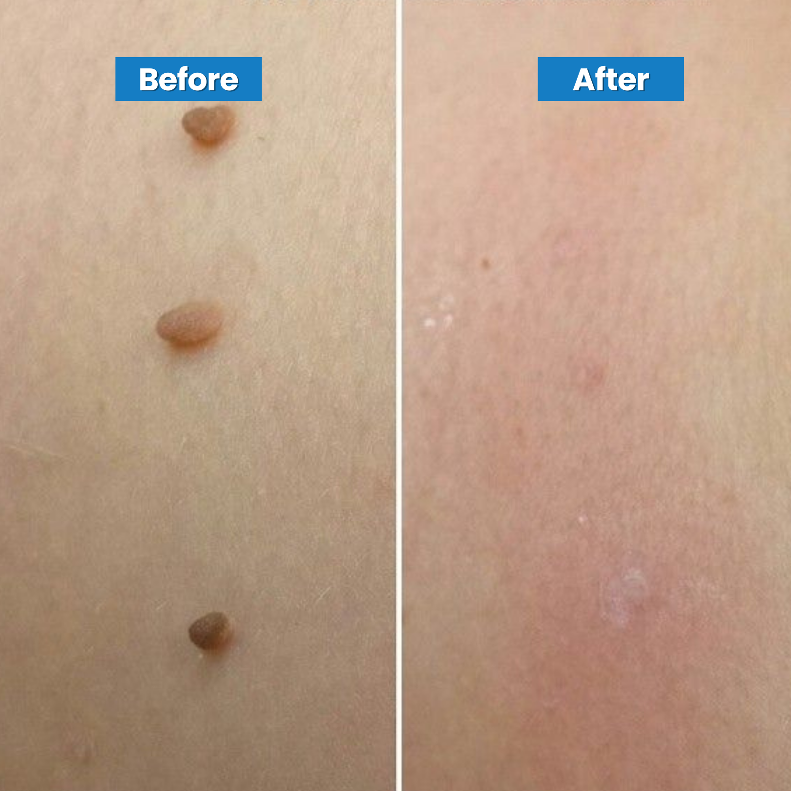 Skin Tag Removal Kit