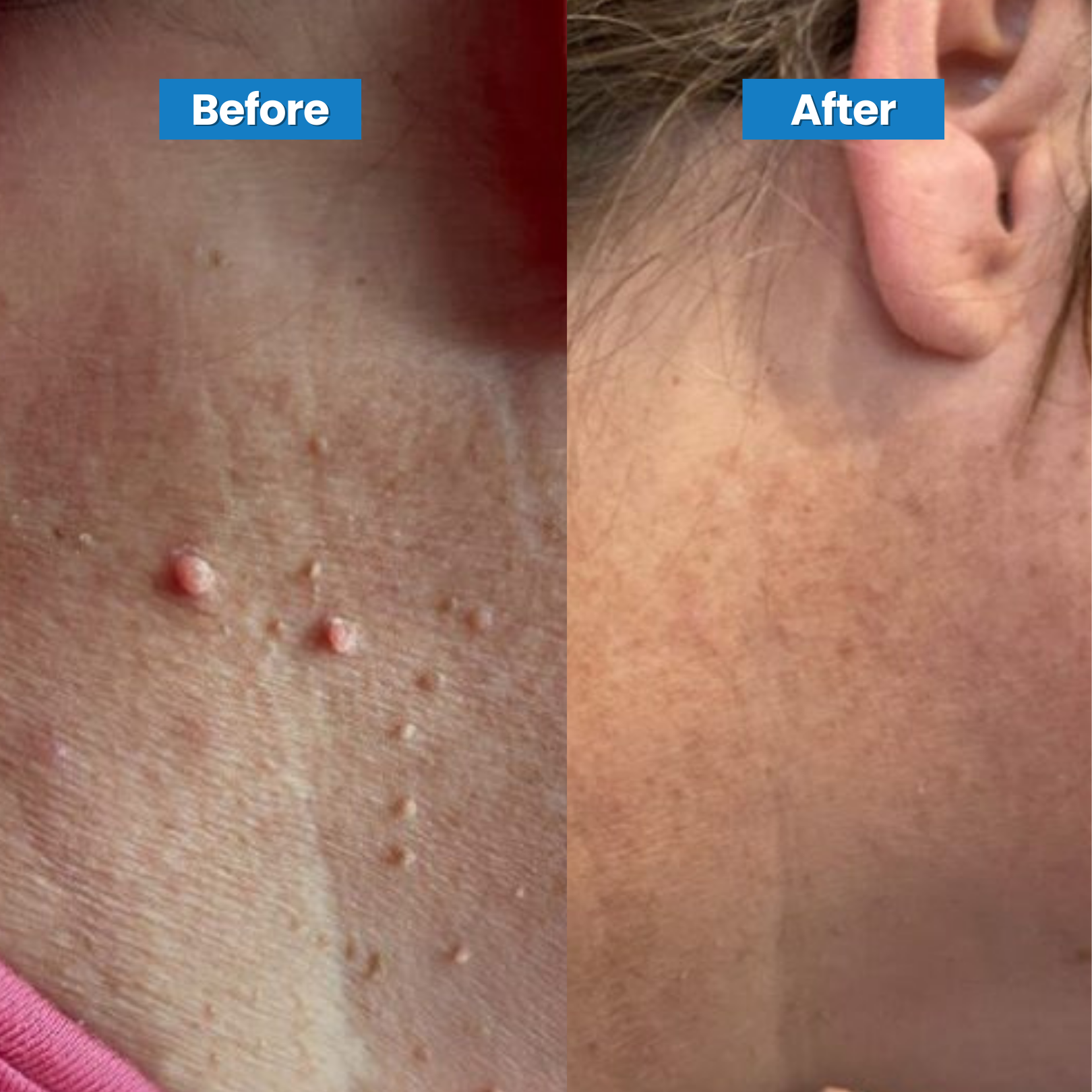 Skin Tag Removal Kit