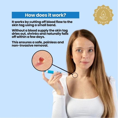 Skin Tag Removal Kit