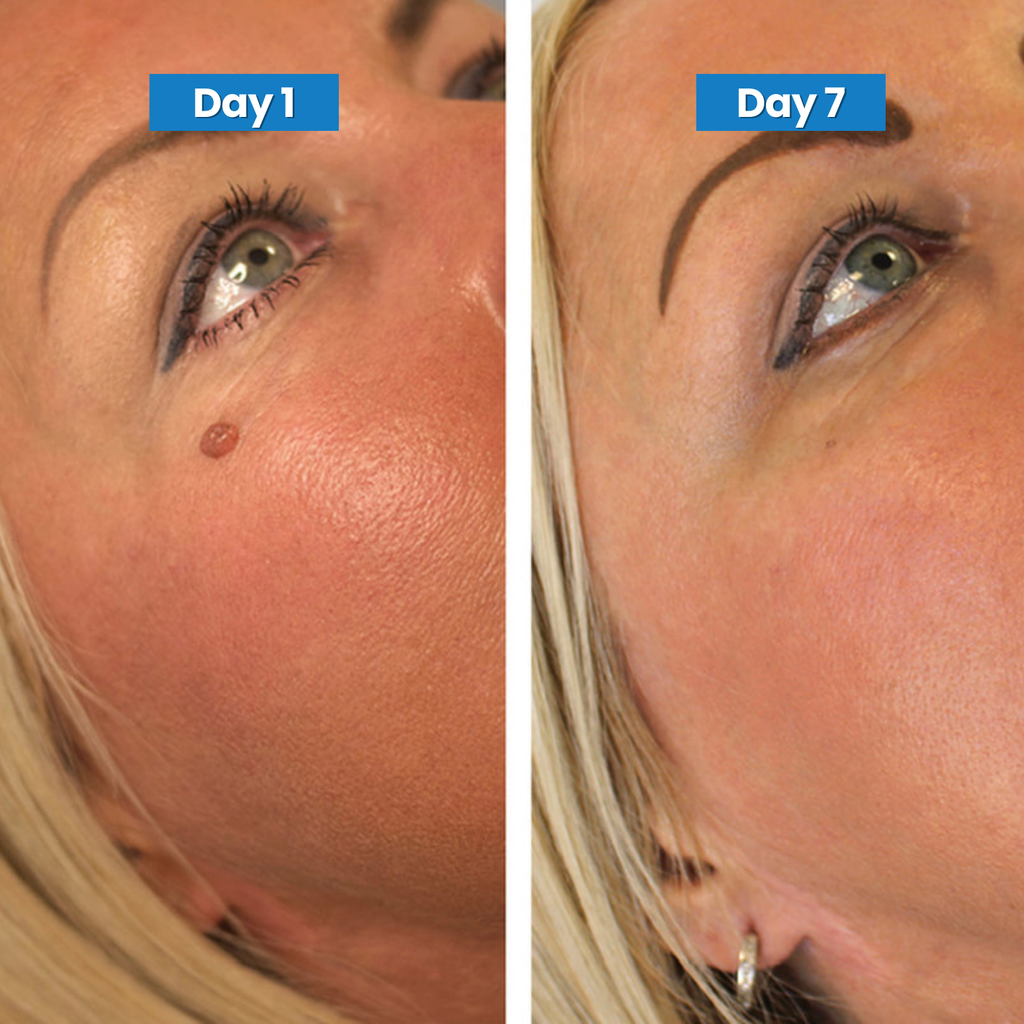Skin Tag Removal Kit