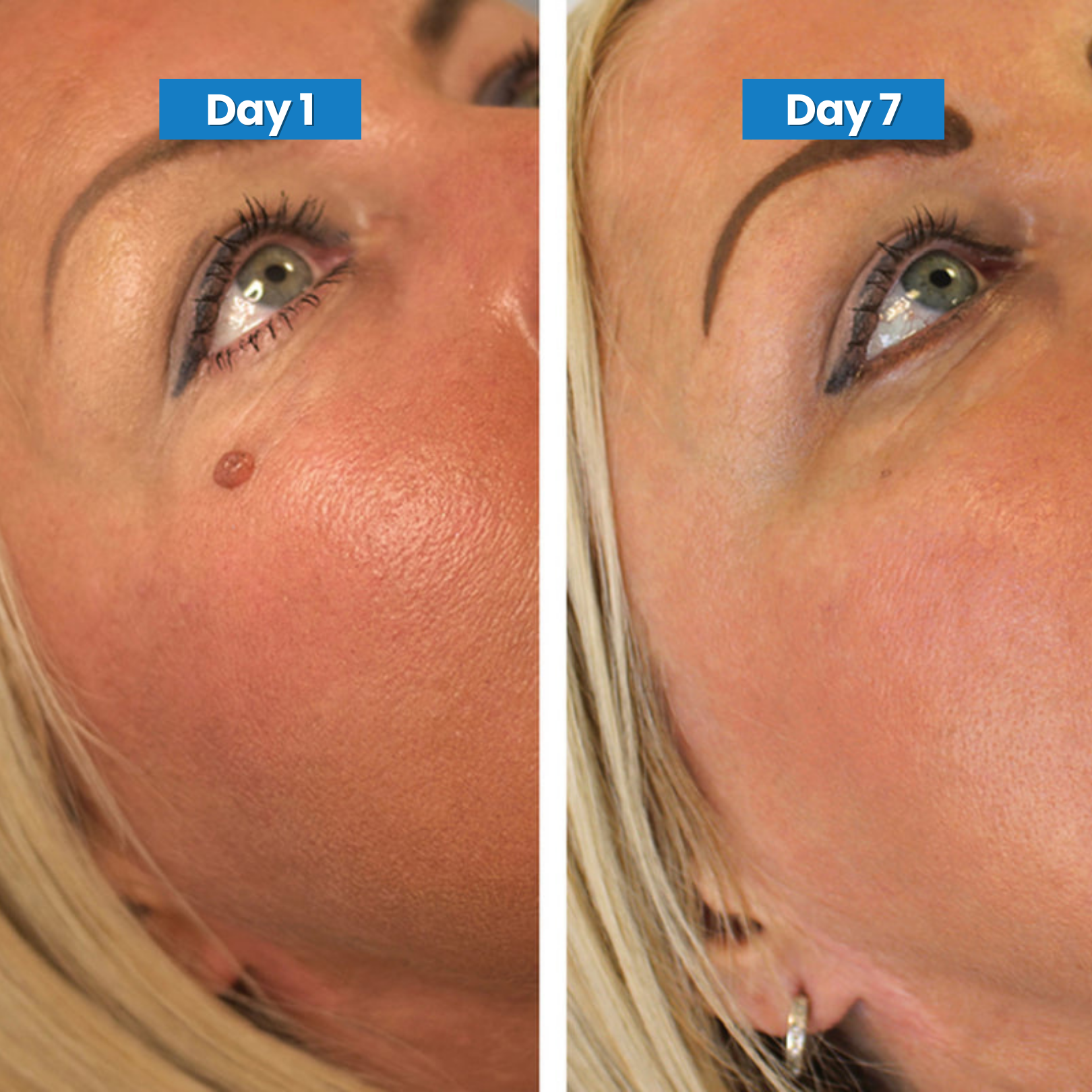 Skin Tag Removal Kit