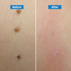 Skin Tag Removal Kit