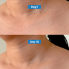 Skin Tag Removal Kit