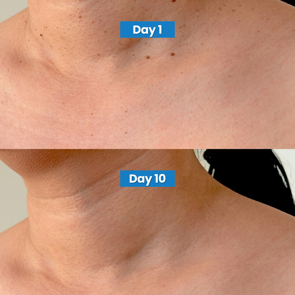 Skin Tag Removal Kit