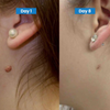 Skin Tag Removal Kit