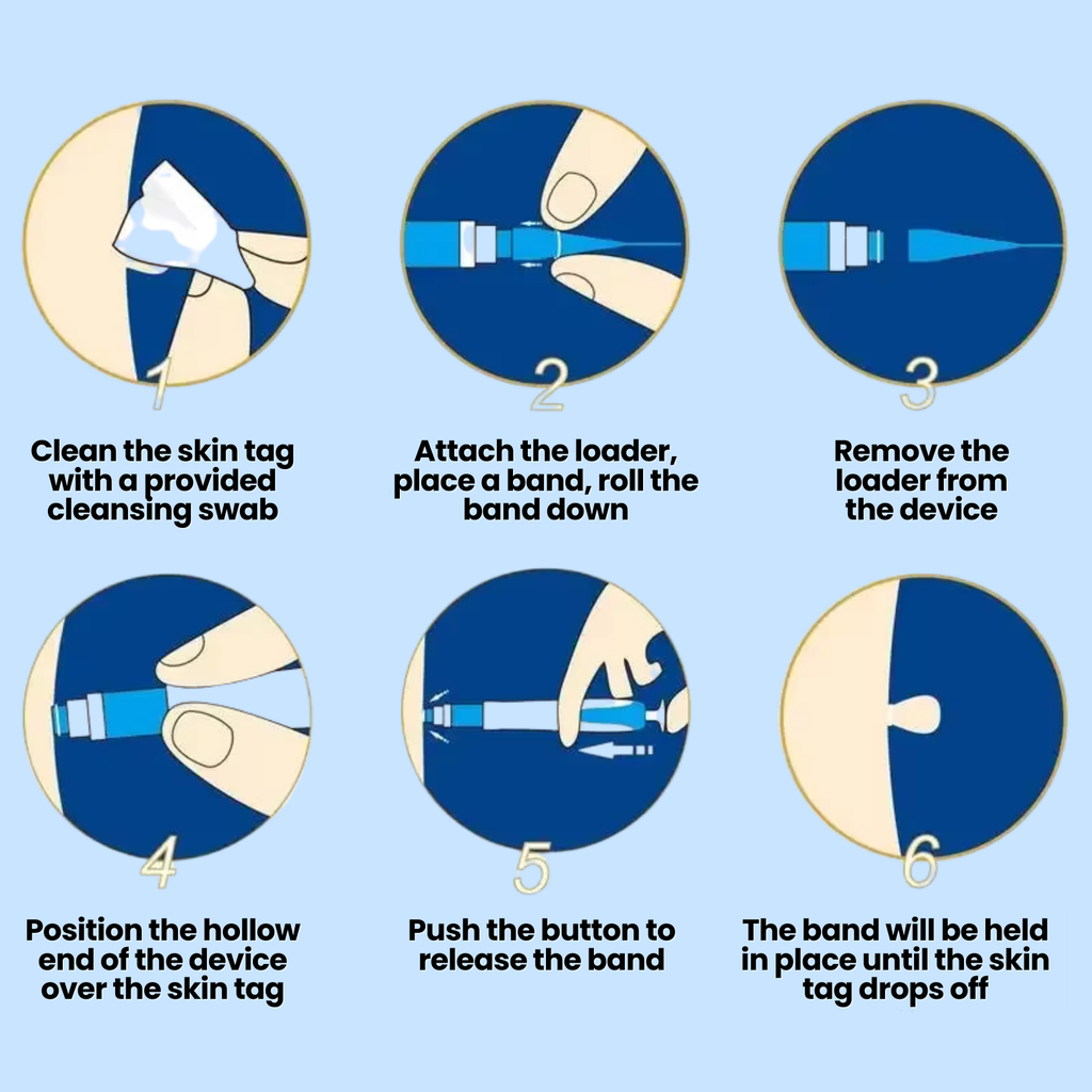 Skin Tag Removal Kit